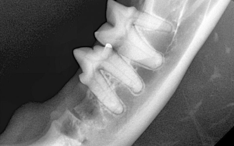 extração de dente com lesão reabsortiva