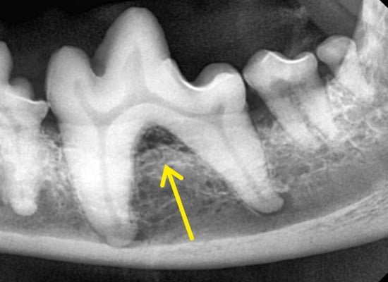 Radiografia dental de região de furca grau 2