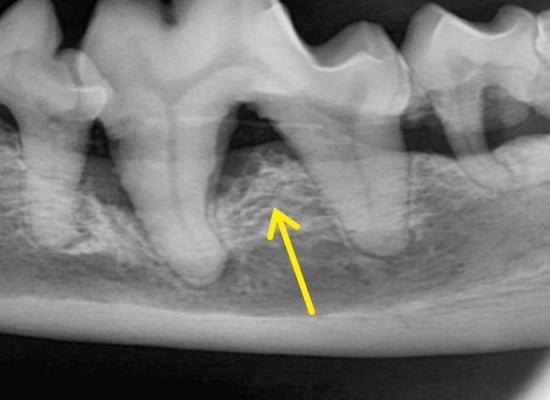 Radiografia dental de região de furca grau 3